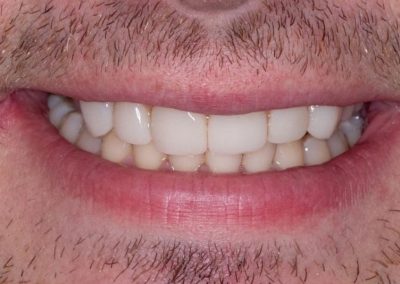 Composite Veneers After1