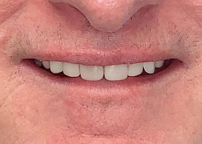 CrownsandBridgeVeneerscombinedwithImplants After1