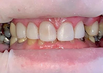 CrownsandBridgeVeneerscombinedwithImplants After2