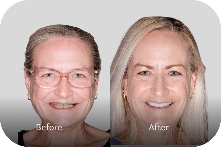 Smile Makeover