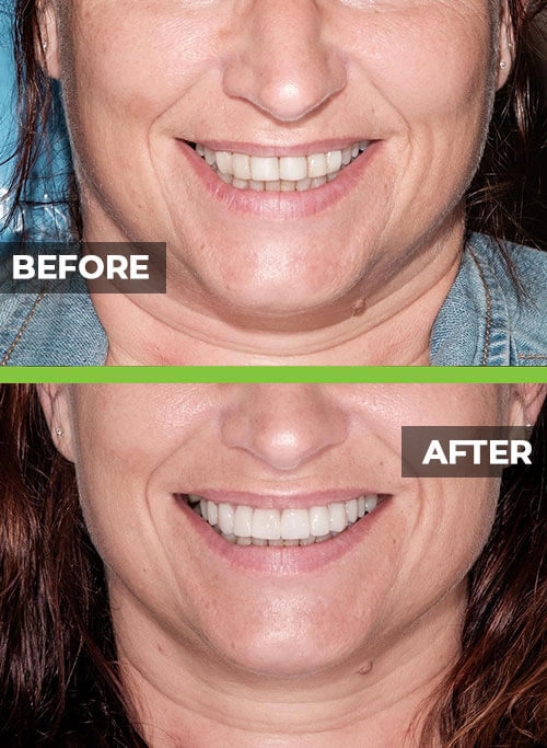 before-after-veneers