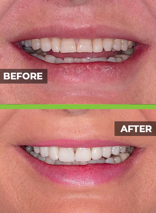 before-after-veneers