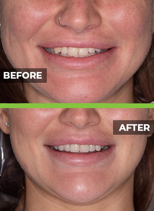 before-after-veneers