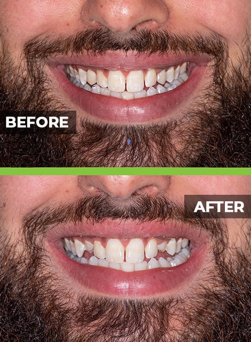 before-after-veneers