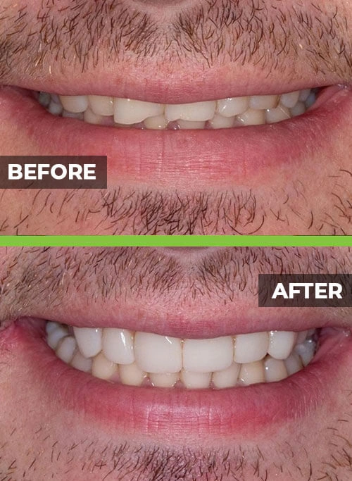 before-after-veneers