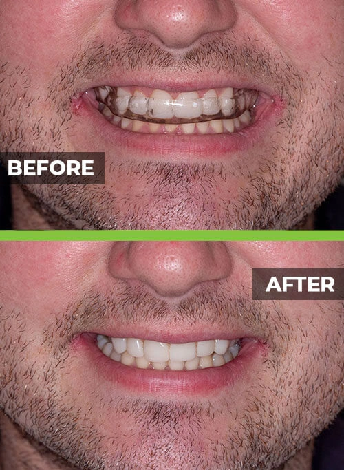 before-after-veneers