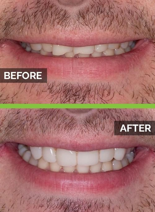 before-after-veneers