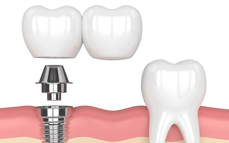 Dental Implants