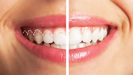 Gum Disease Treatment