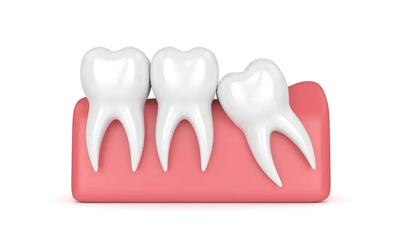 Wisdom Teeth Removal