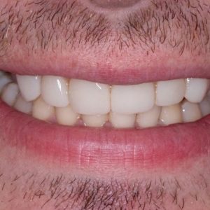 Composite-Veneers-After1