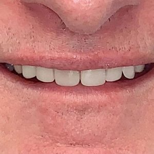 CrownsandBridgeVeneerscombinedwithImplants-After1